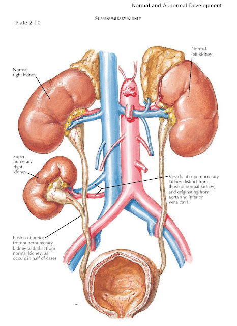 Unilateral renal agenesis