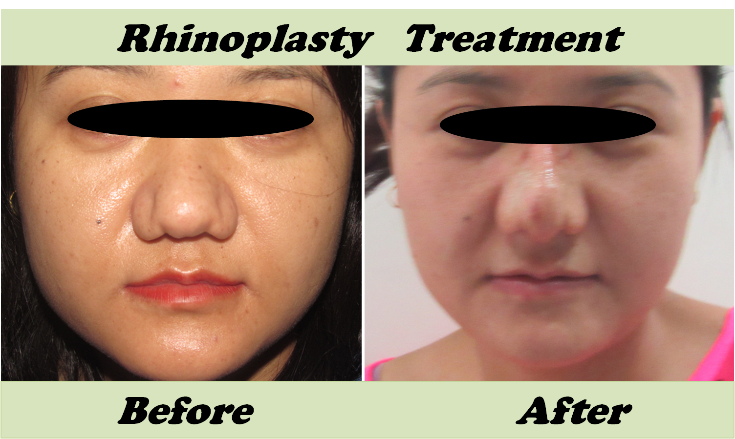 Rhinoplasty/Nose Correction Surgery in Delhi, India ~ Care ...