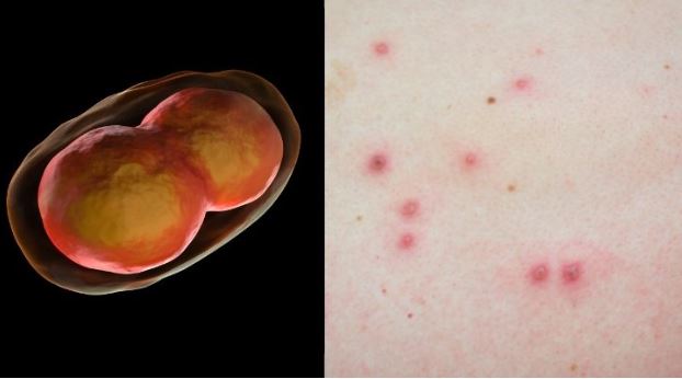 Monkeypox, similar to smallpox, is rare form of viral infection