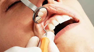 image show Dental Implants