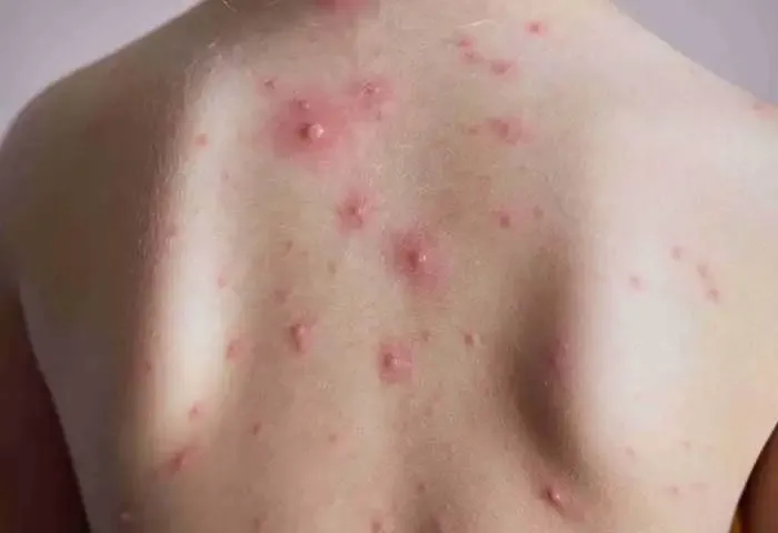 Chickenpox Grips Kerala With Over 6000 cases