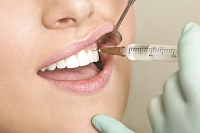 Thực hiện nhổ răng không bị sâu đau không?