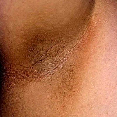 Hyperpigmentation pictures: Acanthosis nigricans