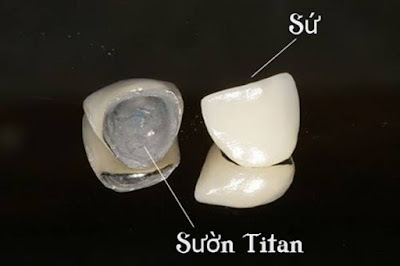 Bọc răng sứ titan được bao lâu? Chăm sóc răng đúng cách -1