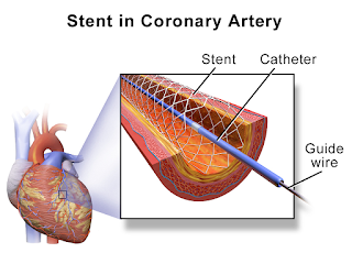 stent insertion and coronary artery