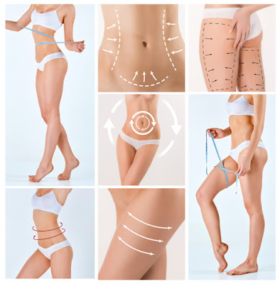 Lipoaspiración y Lipoescultura