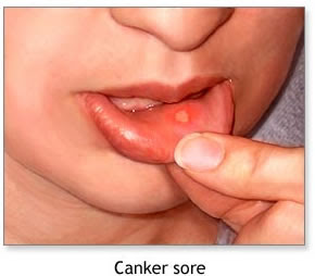 So what are Mouth Canker Sores