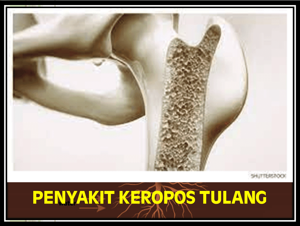 Penyebab Penyakit Keropos Tulang