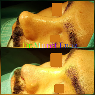 2nd Revision Rhinoplasty Operation in Men, Second Revision Nose Aesthetic Surgery For Male,Revision Rhinoplasty Istanbul,