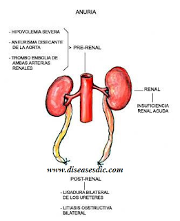 causes of anuria