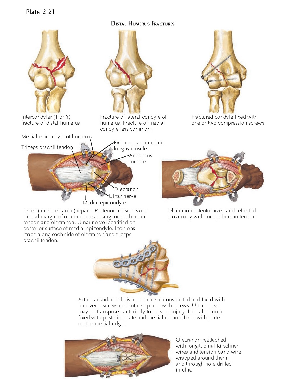 FRACTURE OF DISTAL HUMERUS