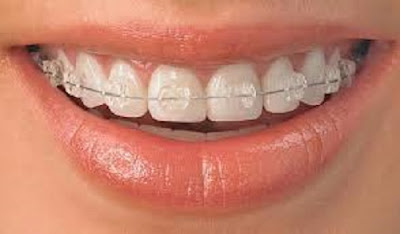 Cách rút ngắn thời gian niềng răng