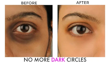 What causes dark circles under the eyes?