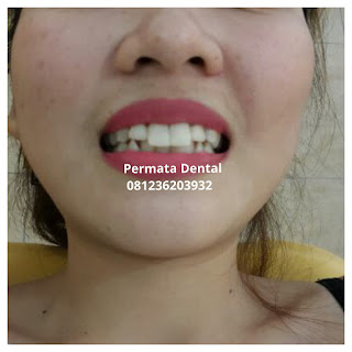 gambar foto contoh sebelum dan sesudah veneer gigi kelinci buatan manis cantik bali jember banyuwangi murah berkualitas di PERMATA DENTAL gambar gigi rusak yang di veneer gigi yang tidak rapi gigi renggang gigi patah cuil rompal pendek karies hitam kuning