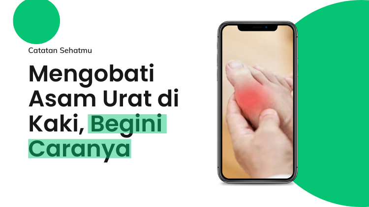 Mengobati Asam Urat di Kaki, Begini Caranya