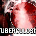 Tuberculosis - Causes, Symptoms and Factors That Could Put You at Risk