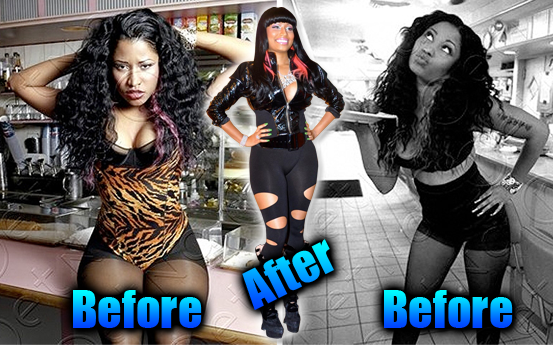 Nicki Minaj before and after butt implants plastic surgery?