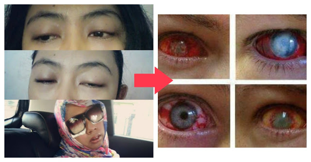 Nggak Mau Kaya Gini Kan Matanya..?? Harap Hati - Hati Saat menggunakan Softlens..!! Bantu Share !!