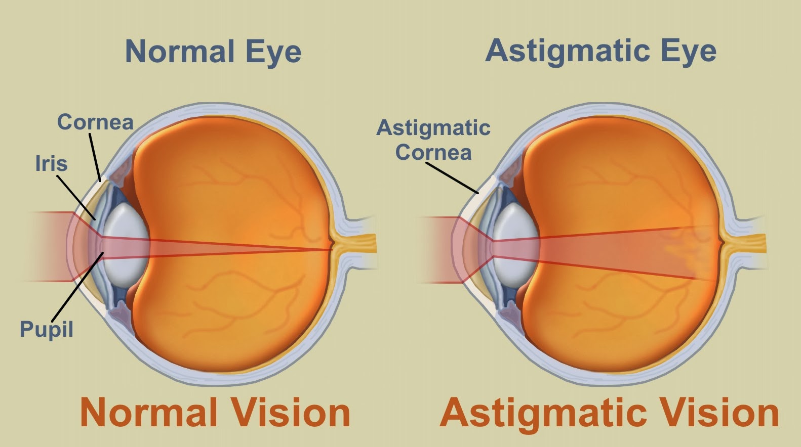 Astigmatism Causes, Symptoms, Diagnosis, Treatment, Prevention Tips
