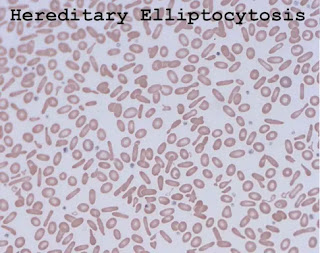 Hereditary elliptocytosis (HE)