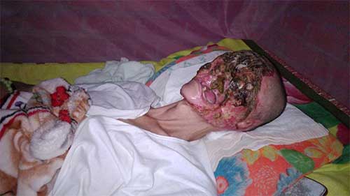Muka Lelaki Ini Hilang Setelah Di Makan Virus