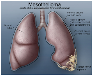 Mesothelioma Lawyers and Mesothelioma Compensation