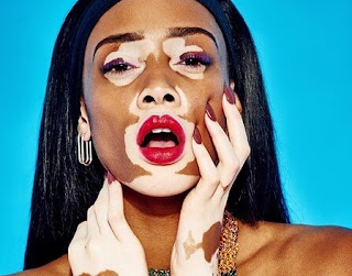 Winnie Harlow, Vitiligo