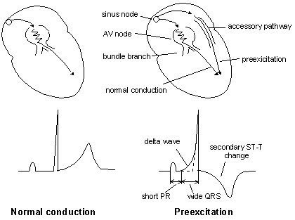 預激症候群 Preexcitation syndrome