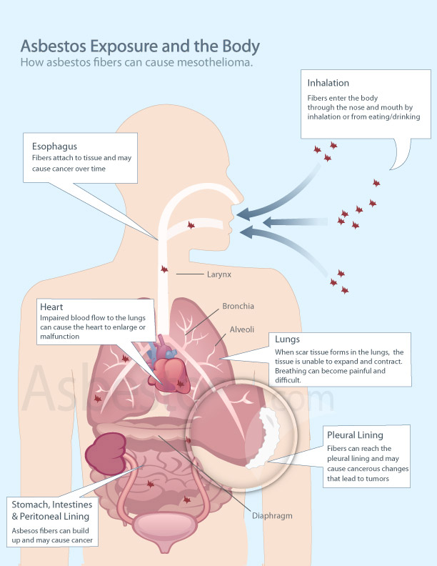 mesothelioma symptoms: Mesotheliom lung cancer symptoms