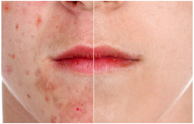 treating-the-causes-of -acne