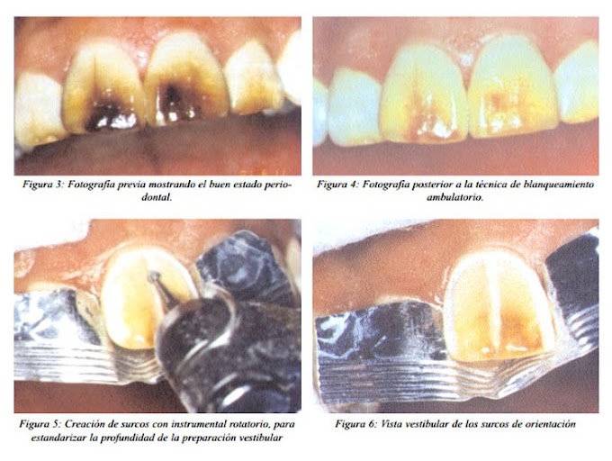 PDF: Carillas Directas con resinas compuestas: una alternativa en Operatoria Dental