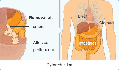 Peritonal Mesothelioma