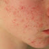 Symptoms of skin conditions