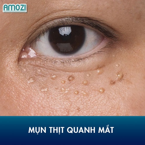 trị mụn thịt hiệu quả