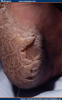 Hyperkeratosis of the sole