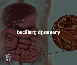 Bacillary dysentery