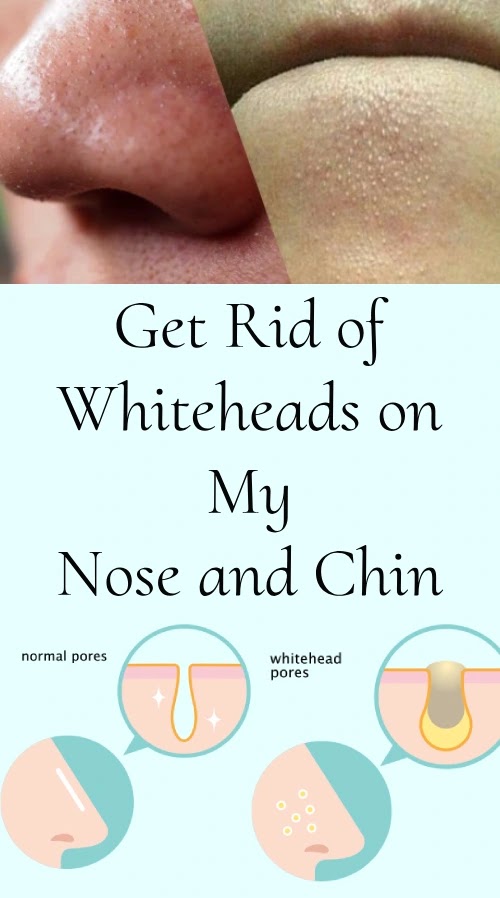 How do I Get Rid of Whiteheads on My Nose and Chin