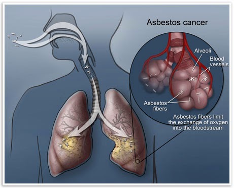 Asbestos Lung Cancer  Mesothelioma  Mesothelioma Treatment 