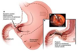 tumor lambung