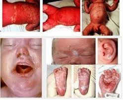 Obat Sipilis Yang Paling Ampuh