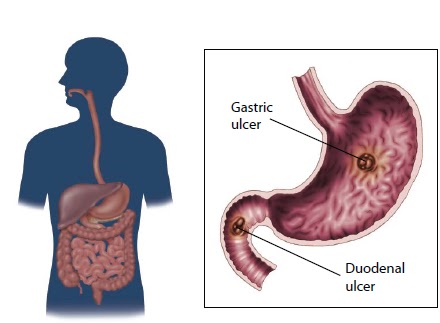 symptoms of stomach cancer tumor the cancer of the stomach