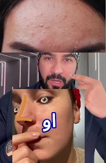 حبوب الجبهة وحبوب في خطوط الابتسامه