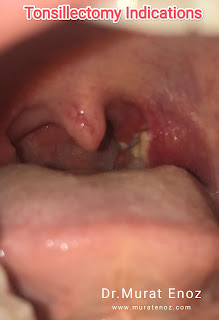 Tonsillectomy Indications