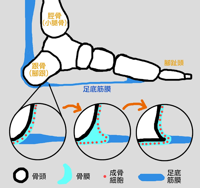 好痛痛 解剖列車 跟骨骨刺 筋膜 足底筋膜 骨膜 成骨細胞