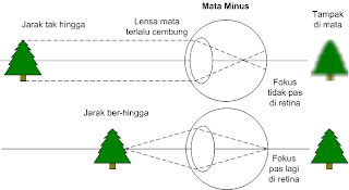 mata minus illustrasi