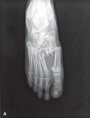 AP Lisfranc Injury