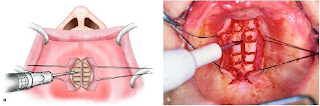 Torus Removal Surgery