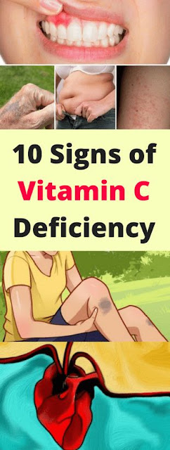 Here 10 Signs Of Vitamin “C” Deficiency!!!
