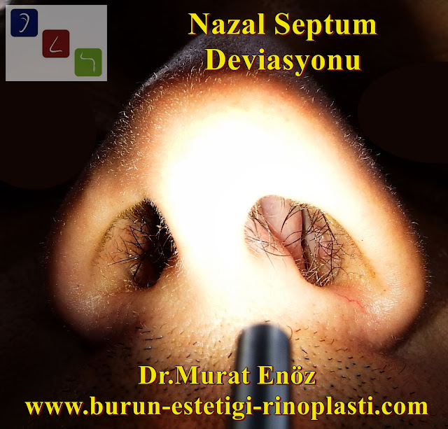 Burunda Nazal Septum Deviasyonu - Nazal Septum Deviasyonu Tanımı - Nazal Septum Deviasyonu Neden Olur? - Nazal Septum Deviasyonu Belirtileri - Nazal Septum Deviasyonu Yatış Pozisyonunu Etkileyebilir! - Burunda Kemik Spur Formasyonu - Nazal Septum Deviasyonu Türleri - Nazal Septum Deviasyonu Tanısı - Nazal Septum Deviasyonu Nasıl Anlaşılır? - Her Nazal Septum Deviasyonu Ameliyat Gerektirmez! - Nazal Septum Deviasyonu Tedavisi - Deviasyon Ameliyatı Nasıl Yapılır? - Deviasyon Ameliyatından Sonra Kıkırdak Eğriliği Tekrarlar mı? - Deviasyon Ameliyatının Riskleri - Deviasyon Ameliyatı Sonrasında Burun Ucu Düşmesi - Deviasyon Ameliyatı Sonrası Yapılması Gerekenler - Burun Kıkırdağı Eğriliği - Burunda Kemik Eğriliği - Nazal Septum Deviasyonu Çeşitleri