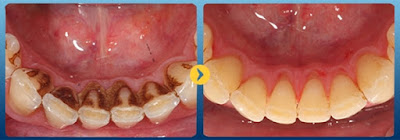Khắc phục tình trạng răng có nhiều cao răng-2
